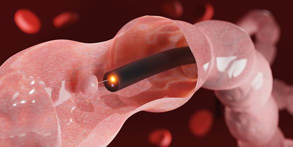 Câmera acoplada a um tubo flexível torna possível a visualização do intestino durante uma colonoscopia. (Fonte: GettyImages/Reprodução)