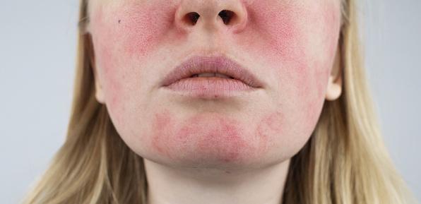 Sintomas da rosácea podem aparecer por todo rosto, mas são mais comuns no centro da face. (Fonte: GettyImages/Reprodução)