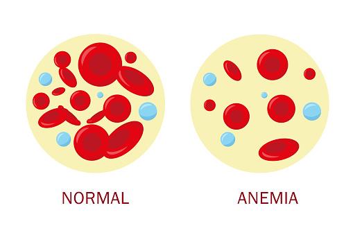 No quadro de anemia há redução da quantidade de glóbulos vermelhos no sangue