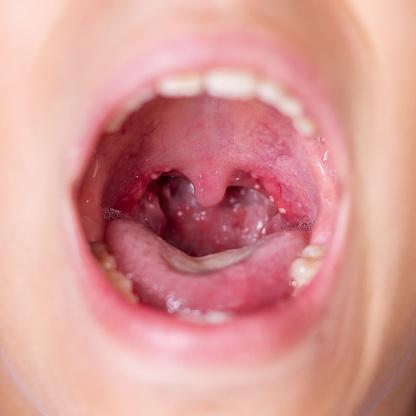 As amígdalas ficam no fundo da garganta. (Fonte: Getty Images/Reprodução)
