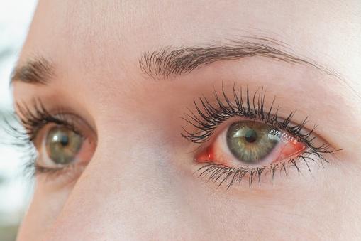 Ocular herpes may be confused with conjunctivitis. 
