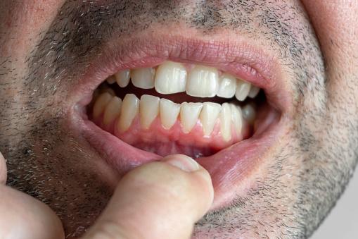 Uso do vinagre de maçã em excesso pode danificar os dentes. (Fonte: GettyImages/ Reprodução)