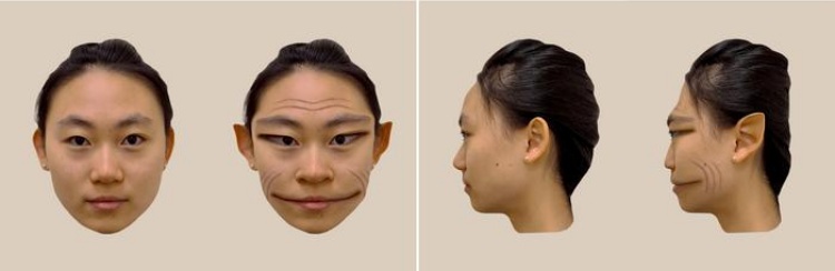Distorções faciais relatadas pelo paciente. (Fonte: The Lancet/Reprodução)