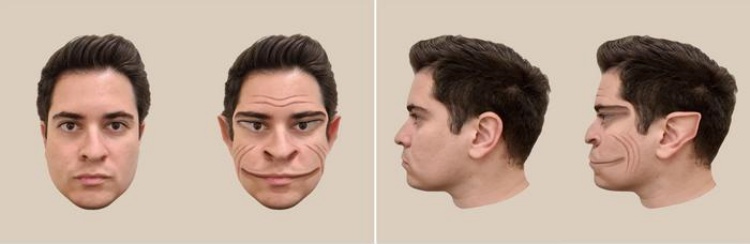 Outro exemplo de distorção facial relatada pelo paciente. (Fonte: The Lancet/Reprodução)
