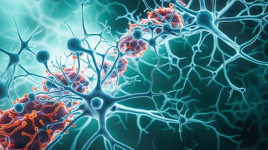 A perda neuronal impulsionada pela doença é o que provoca a perda de memória e a confusão mental. (Fonte: Getty IMages/Reprodução)