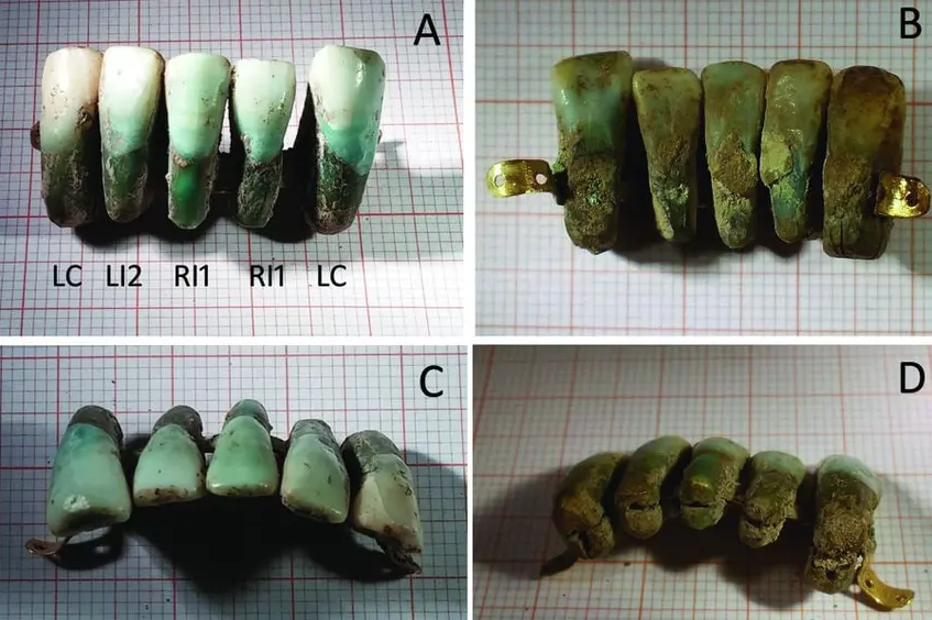 Dentes encontrados na Itália possuem mais de 400 anos. (Fonte: University of Pisa/Reprodução)