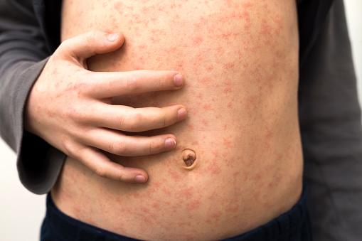 O sarampo é uma das doenças que podem ser erradicadas com a vacinação. (Fonte: Getty Images/Reprodução)