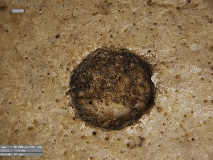 Tumor do tamanho de uma moeda em um dos crânios. (Fonte: Frontiers in Medicine/Reprodução)